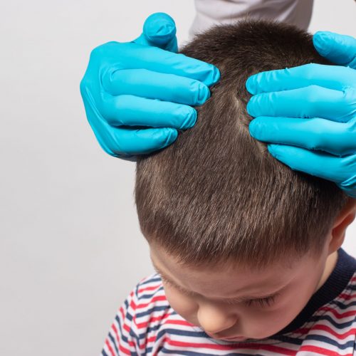 The pediatrician in the gloves will check the presence of lice and nits in a small child. Pediculosis in kindergarten, preventive examination of the head and hair